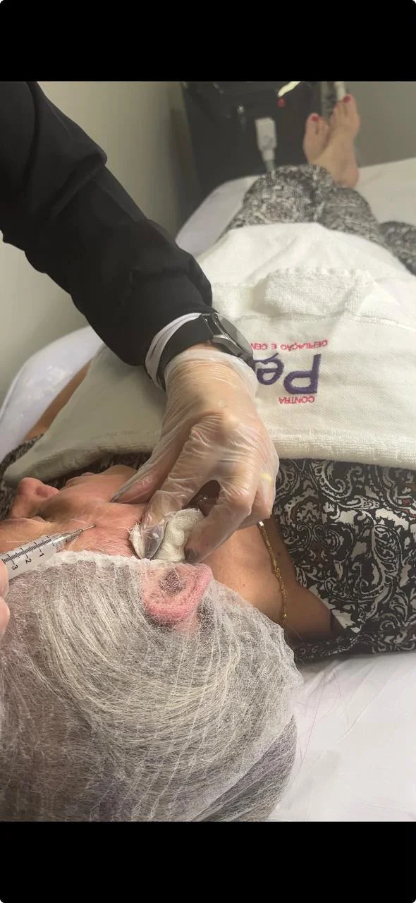aplicação de bioestimuladores de colágeno preço