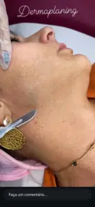 Dermaplaning
