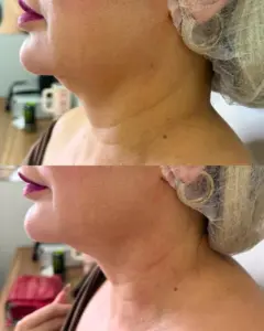 Lipo de Papada