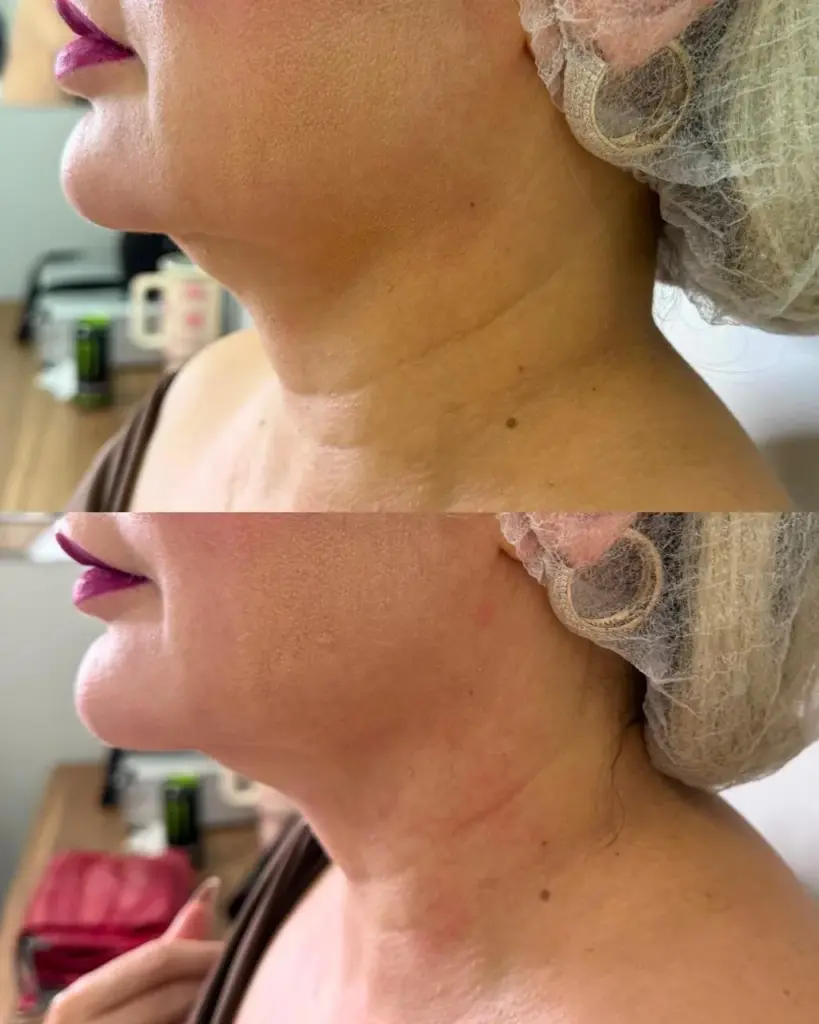 Lipo de Papada