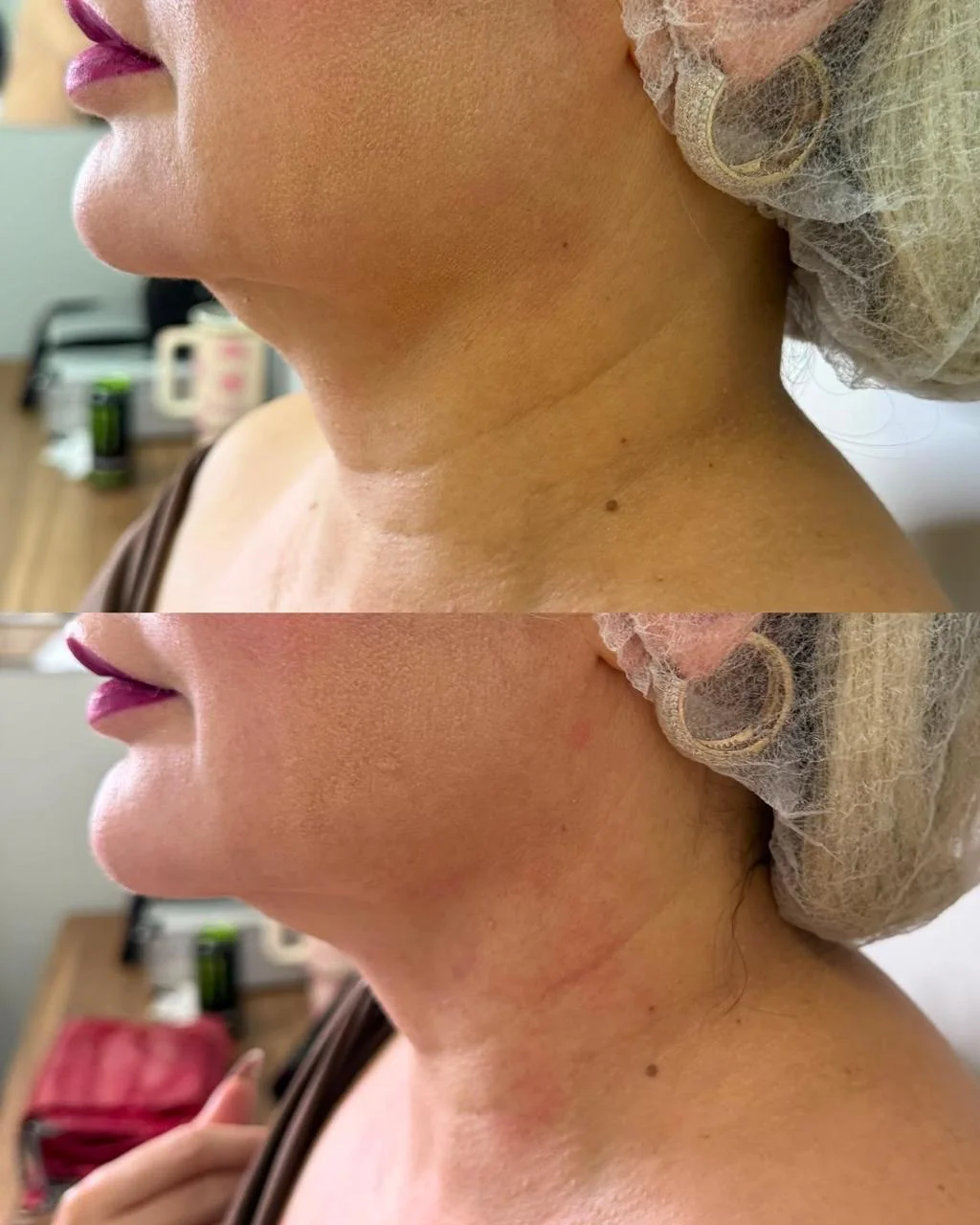 Lipo de Papada