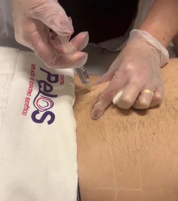 Hidrolipoclasia