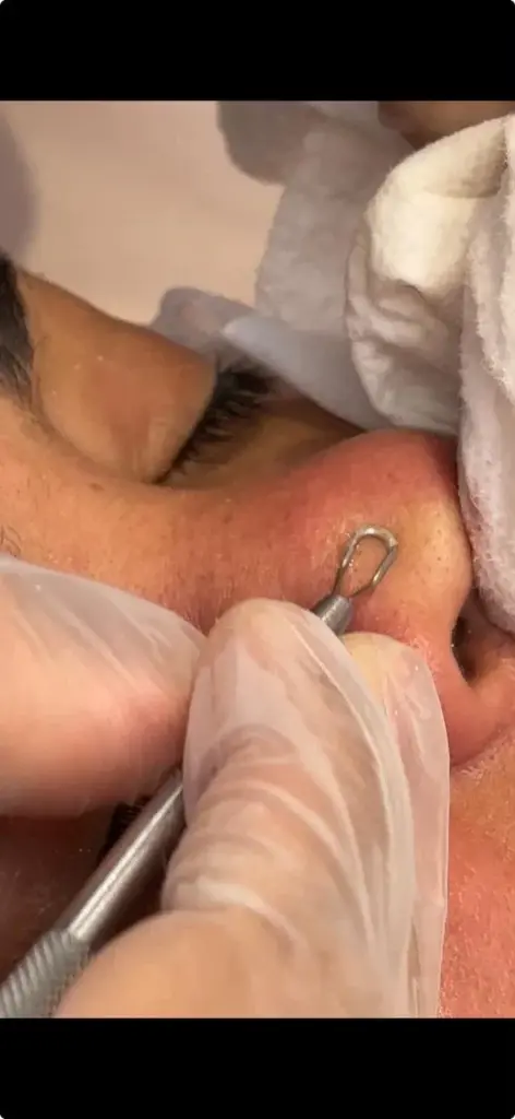 Limpeza de Pele
