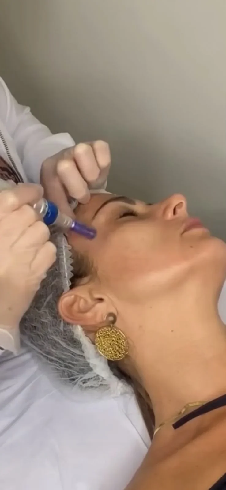 Microagulhamento Facial