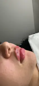 Preenchimento Labial