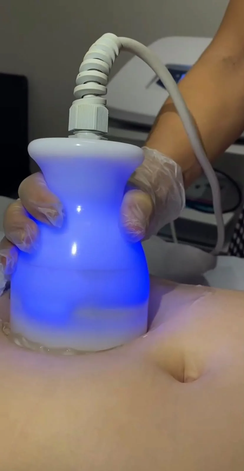 Lipocavitação