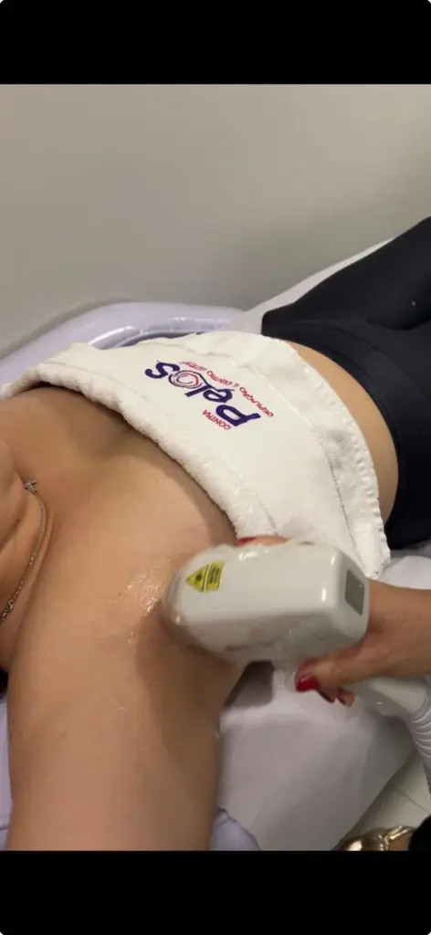 Depilação a laser